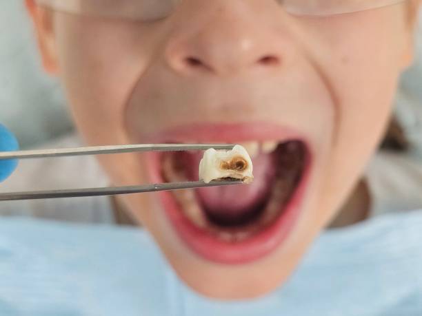 Emergency Dental Filling Replacement in MS